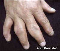 Pachydermodactyly: מחלה תעסוקתית של עובדים בתעשיית עיבוד העופות